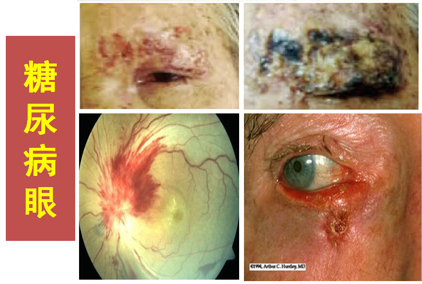 糖尿病眼.jpg
