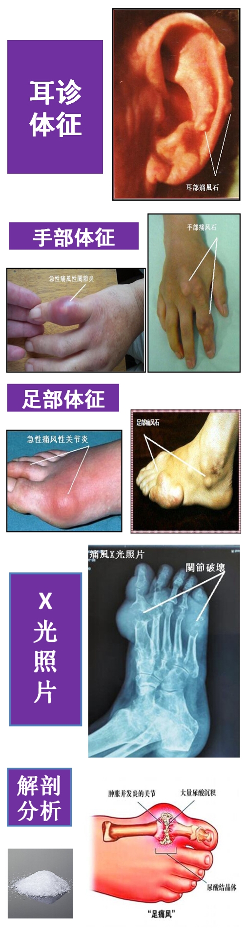 痛风体征z.jpg